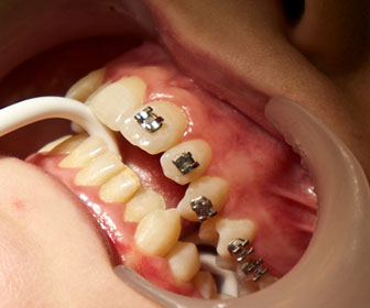 Frenos dentales