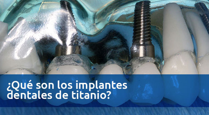 Que-son-los-implantes-dentales-de-titanio