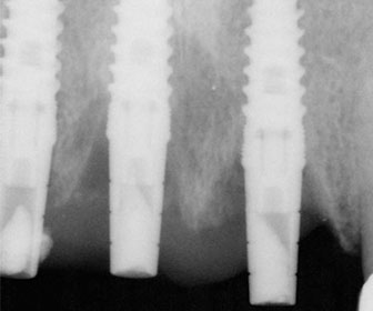 implantes de dientes de titanio