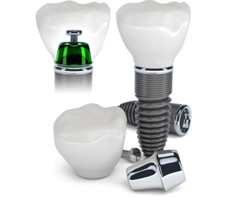 implantes dentales de titanio