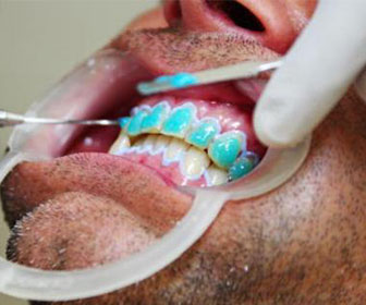 paciente listo para brakets dentales