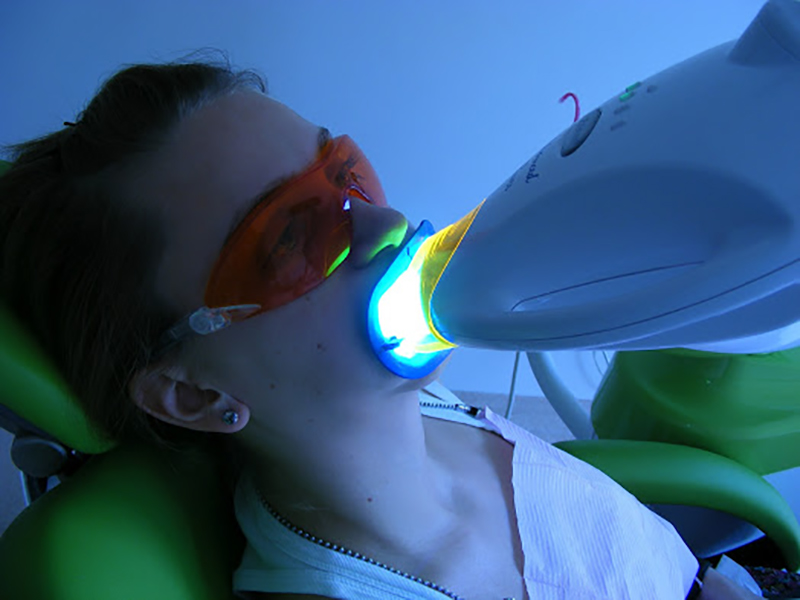 como-es-una-limpieza-dental-con-laser