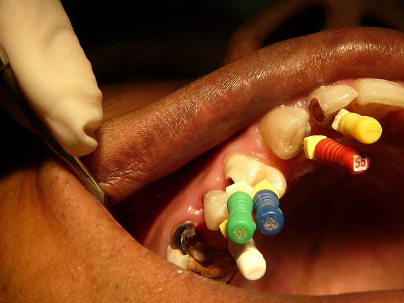 la-endodoncia-en-molares