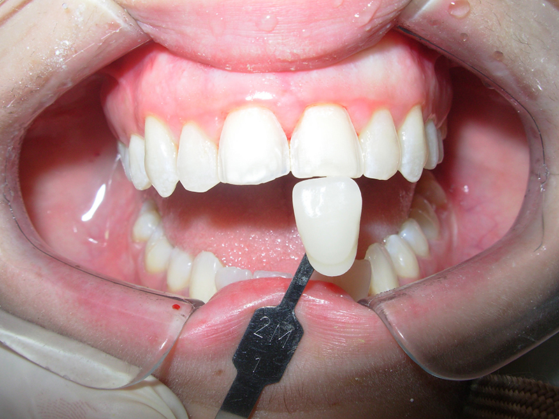 los-tipos-de-protesis-dentales