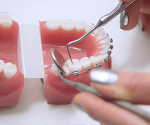 dentistas-en-tijuana-brackets