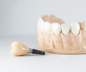 implante-dental-se-puede-trabajar