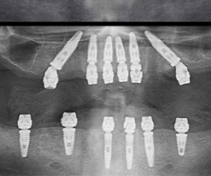 donde-encontrar-implantes-dentales-economicos-en-tijuana