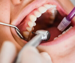 puede-dar-la-impresion-de-que-solo-es-cuestion-de-dar-un-mantenimiento-general-de-los-dientes-removiendo-sarro-y-placa-bacteriana-dentista-tjuana