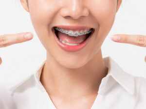 encontrando-el-mejor-precio-de-ortodoncia-en-tijuana-dentista-tijuana