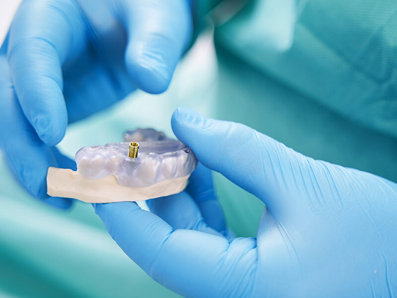tipos-de-implantes-dentales-cual-es-el-mejor-para-ti-dentista-tijuana