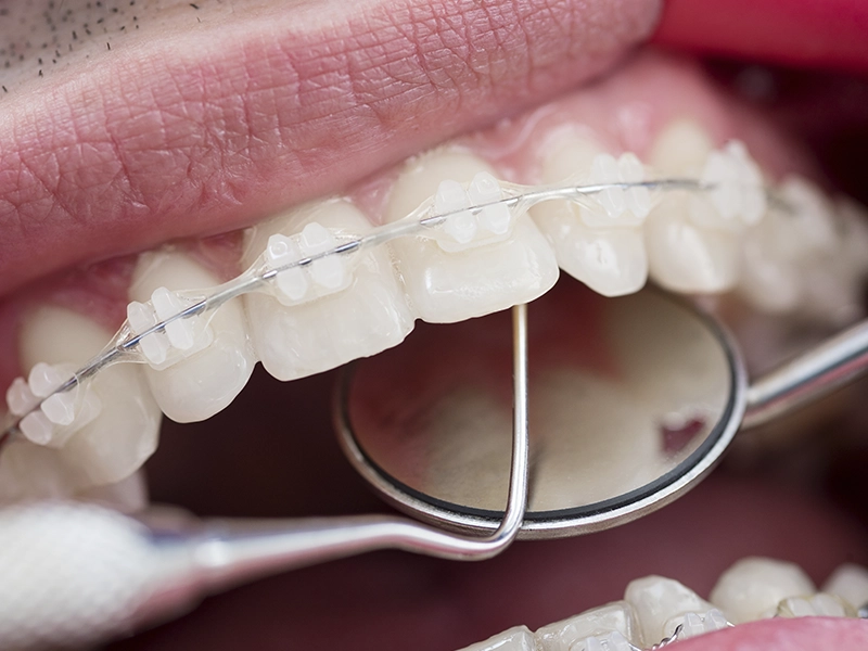 evita-las-manchas-marrones-en-los-dientes-por-brackets-dentista-tijuana