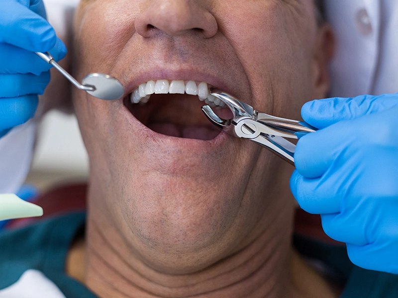 sigue-estos-consejos-para-extraccion-de-muela-sin-dolor-dentista-tijuana