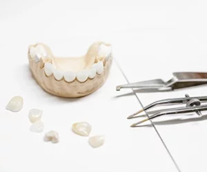 son-finas-laminas-de-material-que-se-adhieren-a-la-parte-frontal-de-los-dientes-dentista-tijuana