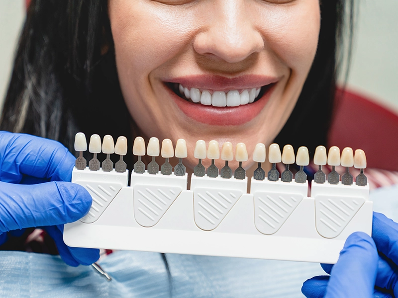 que-carillas-dentales-son-las-mejores-segun-la-ciencia-dentista-tijuana