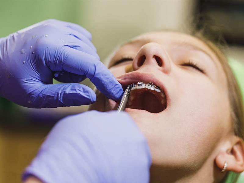 cuanto-duran-los-brackets-y-que-considerar-al-elegirlos-dentista-tijuana