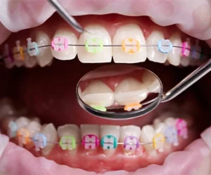 el-tratamiento-puede-variar-significativamente-dependiendo-de-cada-paciente-dentista-tijuana
