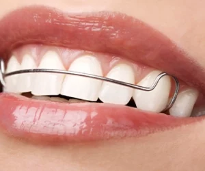 la-duracion-de-un-tratamiento-de-ortodoncia-puede-variar-significativamente-de-una-persona-a-otra-dentista-tijuana