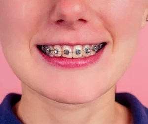 los-dientes-manchados-por-brackets-pueden-deberse-a-la-acumulacion-de-placa-dentista-tijuana