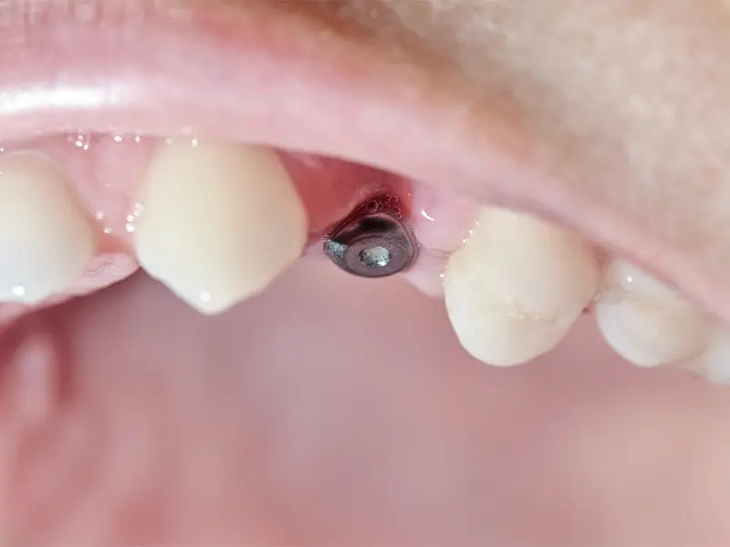 ojo-cuantos-implantes-dentales-se-pueden-hacer-en-un-dia